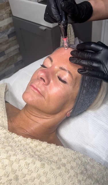 Microneedling Treatment in Process on Sue 2024